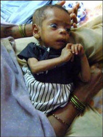 Roshni weighs 6.3 lbs.-- her weight should be more like 10 lbs. About 60% children in India's Madhya Pradesh state are malnourished.  Photo: BBC
